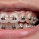 Brasssmile